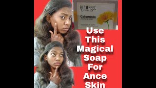 Quick result for anti acne in tamilRichfeel calendula soap reviewmagical result for acne skin [upl. by Essilem558]