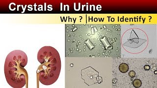 Crystals In Urine  Why amp How to Identify [upl. by Jemie]