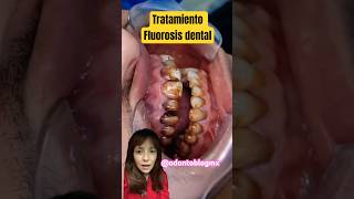 Tratamiento Fluorosis dental shorts fluorosis fluorosisdental odonto dientesmanchas [upl. by Alegnatal]