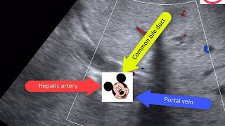 Hepatobiliary ultrasound Two cases [upl. by Floria]