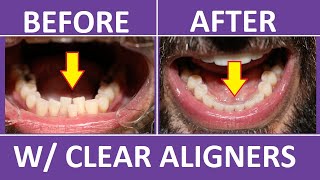 Invisalign Braces Before and After Overbite Crowding Teeth Cost Pain Tips 3M Clear Aligners [upl. by Lorenzana274]