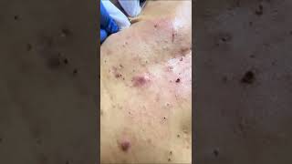 Blackheads Removal  Acne Treatment and Very Satisfying Satisfying Pimple pop blackheads [upl. by Kolnick]