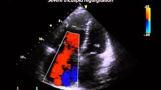 15 Severity of tricuspid regurgitation [upl. by Rafael]