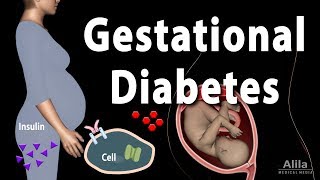 Gestational Diabetes Animation [upl. by Edaw804]