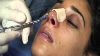 The Kotler Nasal Airway  Removal of the Airway [upl. by Deb837]