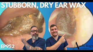 SUPER STUBBORN DRY EAR WAX REMOVAL  EP952 [upl. by Blatt]