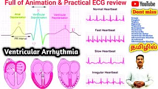 Ventricular Arrhythmia in tamil  couplet triplets flutter Fibrillation bigeminy trigeminy [upl. by Yhtir864]