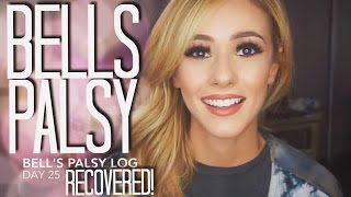 Bells Palsy Recovery and Home Remedies  Day 25 amp Recovered [upl. by Natalee]