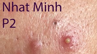 Acne Treatment Huong Da Nang 029  Treatment for Nhat Minh Part 2 [upl. by Ongun672]