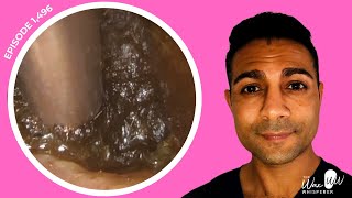 1496  Totally Blocked Ear Wax Removal [upl. by Ruamaj]