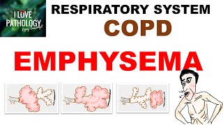 Chronic Obstructive Pulmonary Disease Part 1 Emphysema Pathology [upl. by Jarid297]