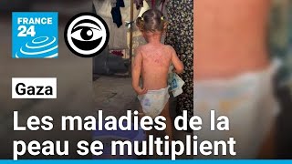 Gaza  propagation alarmante des maladies de la peau • Les Observateurs  France 24 [upl. by Cacie]