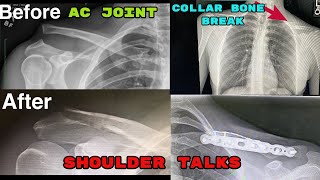 TALKING Shoulder Surgery  AC Joint Separation vs Collar Bone Break PART 1 [upl. by Manly55]