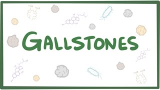 Gallstones cholelithiasis [upl. by Akire624]