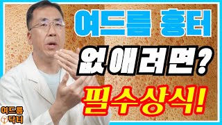 여드름 흉터❗없애려면❓필수상식❗ 여드름흉터 여드름흉터없애는방법 여드름흉터없애는법 여드름자국 [upl. by Wynny]