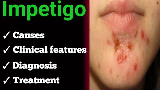 impetigo  causes  clinical features  diagnosis  treatment [upl. by Mehalick]