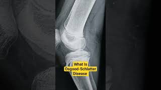 What Is OsgoodSchlatter Disease Dr Sai Chandra osgoodschlatterdisease [upl. by Ahsemo]