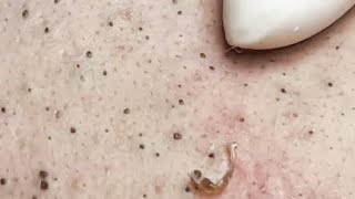 LOOK AT THIS FACE HOW IS FULL OF BLACKHEADS 😨SATISFYING VIDEO relaxing blackheads [upl. by Urbain899]