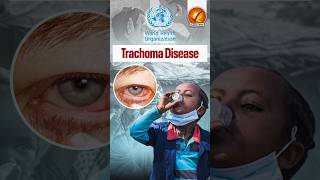 Trachoma Disease shorts [upl. by Evot]