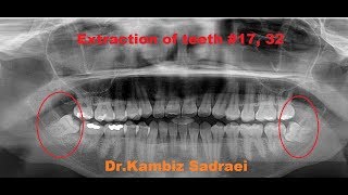 Extraction of Wisdom Teeth 17 amp 32 by DrKambiz Sadraei [upl. by Betteann504]