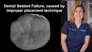 Dental Sealant Failure caused by improper placement technique [upl. by Ahsitra]