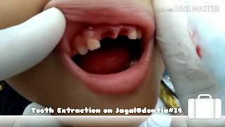 Cabut Gigi AnakanakCabut Gigi Anak GoyangTooth Extraction [upl. by Kurtis150]