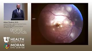 Uveitis Presentations [upl. by Alehtse]