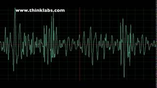 Atrial Septal Defect [upl. by Akeit]