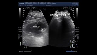 Ultrasound Video showing Two large ureteric stones [upl. by Aikkin]