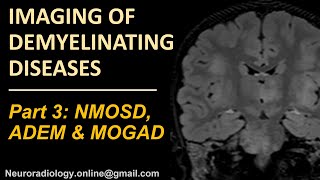 Imaging of demyelinating disorders part 3  NMOSD MOGAD and ADEM [upl. by Misa]