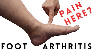 Foot Arthritis Pain Most Common Signs and Symptoms [upl. by Nilekcaj]