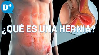 Hernias ¿Qué es una hernia y por qué se produce [upl. by Nodrog698]