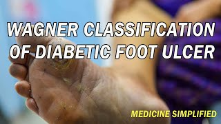 Wagner Classification of Diabetic Foot Ulcers  Diabetic Foot Ulcers Types [upl. by Merle]