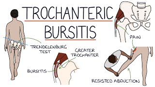 Understanding Trochanteric Bursitis [upl. by Carr]