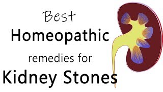 Best homeopathic medicine for stone in kidney  Dr Sanjay Panicker [upl. by Ociredef311]