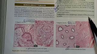 Fibroadenoma fully Explained Pathology ⚕️ [upl. by Kesia]