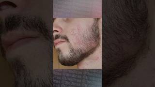 1 ANO E 6 MESES usando Minoxidil minoxidil foligain evolução minoxidil barba barbearia [upl. by Eal426]