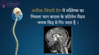 Arnold Chiari Syndrome Syringomyelia and idiopathic Scoliosis in Hindi [upl. by Roseanne]