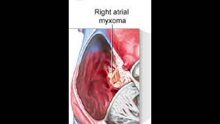 Atrial MyxomaTumor Plop soundIschemiaDr Zeshan Shigri [upl. by Pieter]