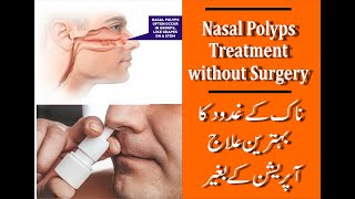 Nasal Polyps Treatment with Homeopathy by Dr Safdar Iqbal [upl. by Allets]