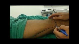 Lateral approach popliteal sciatic block  Peripheral nerve stimulator PNS [upl. by Dao]