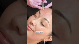 Getting a Redensity 1 treatment with Dr Christine Hall skincare antiaging [upl. by Chalmers576]