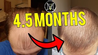 3500 grafts 45 month FUE Hair Transplant result [upl. by Osrit]