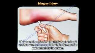 Stingray fish injury  Everything You Need To Know  Dr Nabil Ebraheim [upl. by Dov]