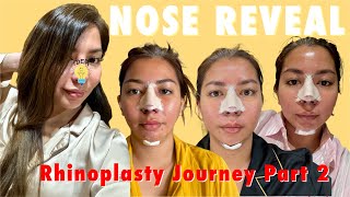 Rhinoplasty Journey Part 2  After Bandage The Final Look   Anna Magkawas [upl. by Spalding]