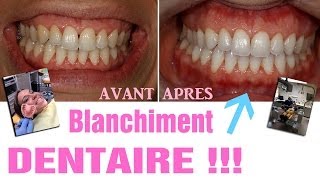 Blanchiment dentaire  AVANTAPRES Revue 25 [upl. by Itsud]