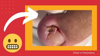 UNHAS ENCRAVADAS 2020 ALIVIO VIDEOS INCRIVEIS NAILED NAILS [upl. by Donelu]