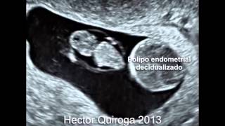 Polipo endometrial decidualizado en un embarazo de 7 semanas y 5 dias [upl. by Htelimay634]