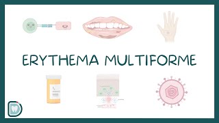 Erythema Multiforme EM Causes Diagnosis Types and Management [upl. by Kegan]