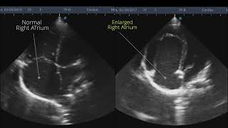 Ebsteins anomaly  Point of Care ECHO  Short Video [upl. by Resneps614]